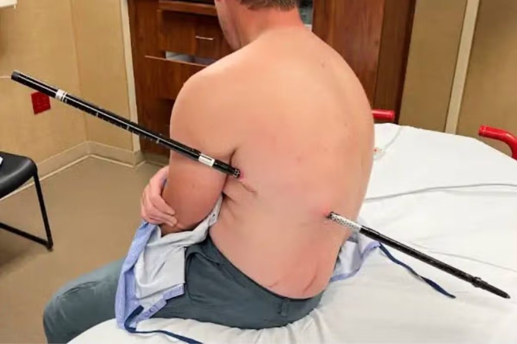 Montana nurse impaled by a 44-inch trekking pole walks 10 miles down mountain to safety