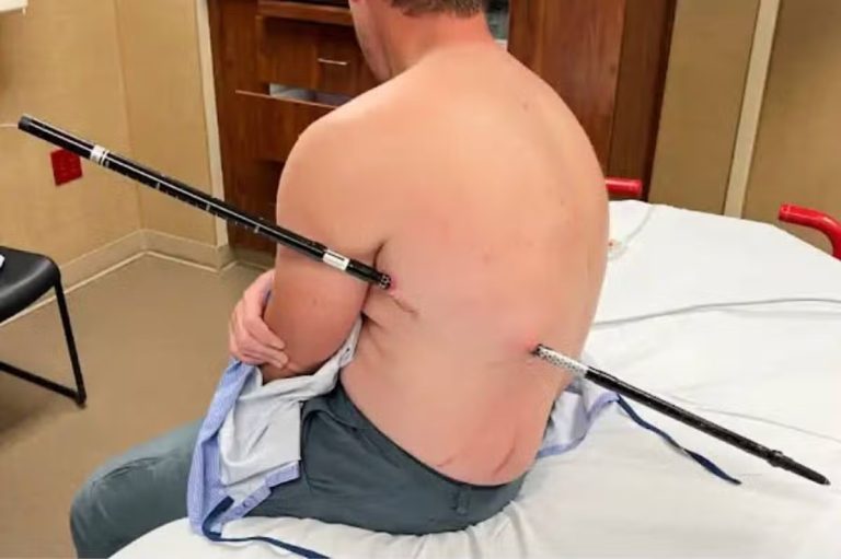 Montana nurse impaled by a 44-inch trekking pole walks 10 miles down mountain to safety